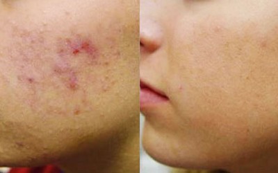 Acne – How You Can Treat Stubborn Pimples – Part 1