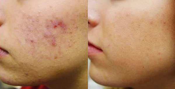 Acne – How You Can Treat Stubborn Pimples – Part 1