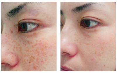 Treatments for Hyperpigmentation – Lasers and More!