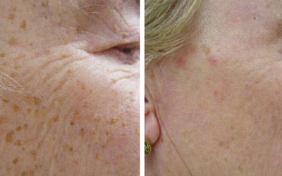 Other Treatments for Hyperpigmentation – Part 1
