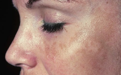 What is Melasma? What Treatment Options Are Available?