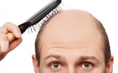 What Is Follicular Unit Extraction (FUE)?