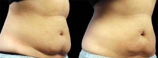 Belly after zeltiq treatment for weight loss