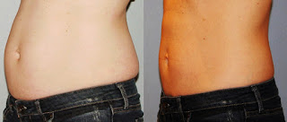 results after coolsculpting treatment