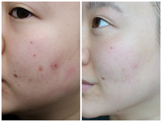 Acne Scars Before & After Light Therapy