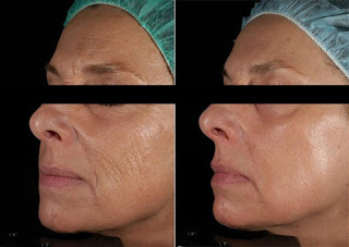 Results after Laser Treatment for Wrinkles