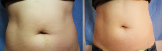 Belly Results After Mesolipo Injections