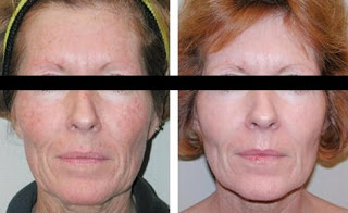 Microdermabrasion Results to Reduce Wrinkles