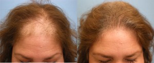 Female Pattern Hair Loss Treatment