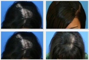FUE Treatment for Female Pattern Baldness
