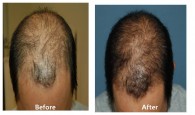 hair loss treatment with prp injection