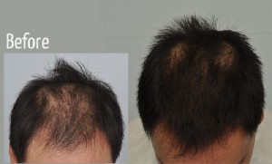 platelet rich plasma therapy for hair loss