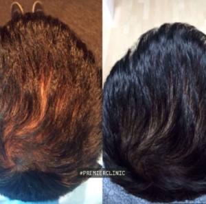 stem-cell-hair-treatment-after-one-month