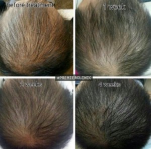 stem cell hair therapy for hair loss problem
