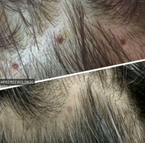Premier Clinic Stem Cell Treatment for Hair Loss
