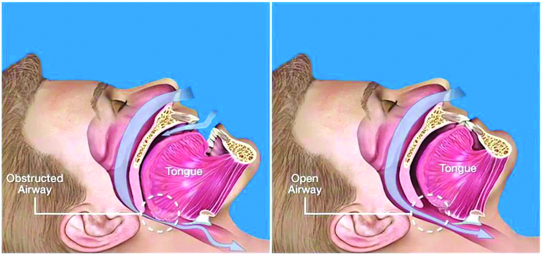 Laser Snoring Procedure Before and After