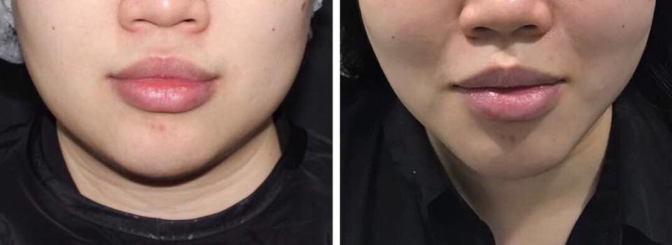 Thread (MINT) Lift Before After