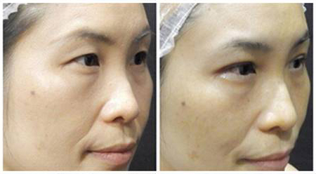Double Eyelid Stitching Before & After 03