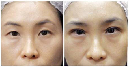 Double Eyelid Stitching Before & After 02