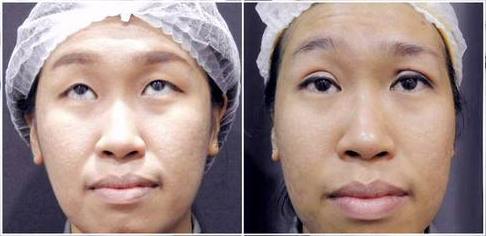Double Eyelid Stitching Before After