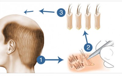 Follicular Unit Extraction (FUE) Hair Transplant