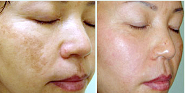 Spectra-Laser-Toning-Before-After-1
