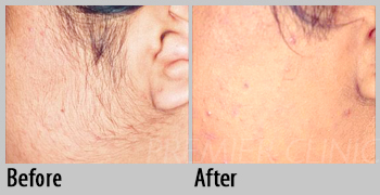 Permanent Laser Hair Removal, Premier Clinic