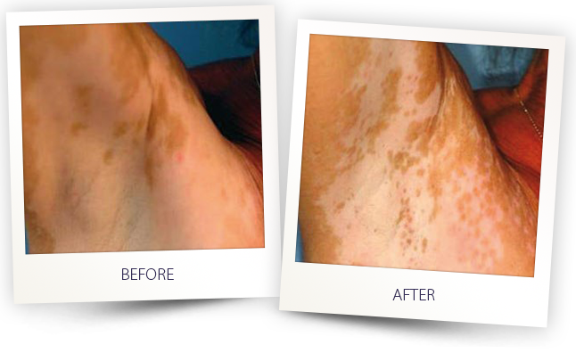 vitiligo1-excimer-laser1