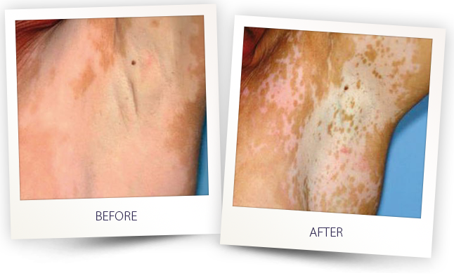 vitiligo2-308-excimer-system1