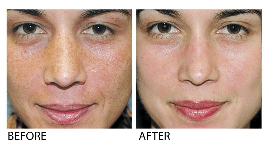 Chemical Peel Simply Peel Signs Of Aging From Your Skin Dr Chen Tai Ho