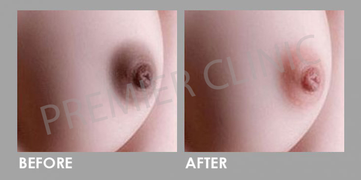 Nipple Whitening Before After