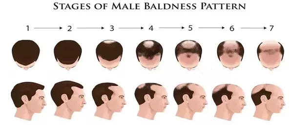 Hair Loss In Asia