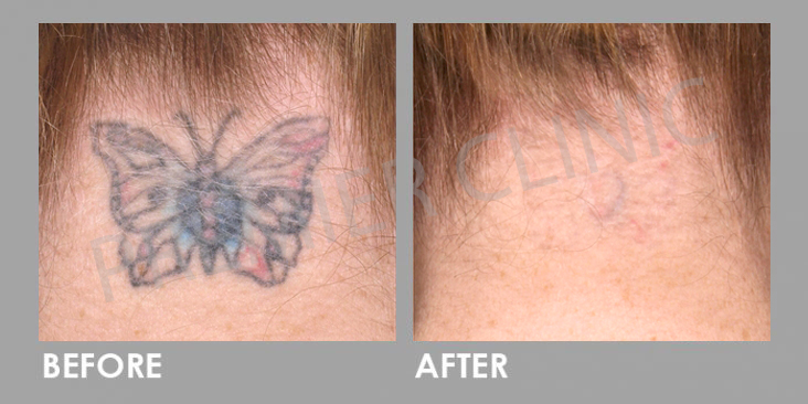 PICO Laser for tatto removal Before After 