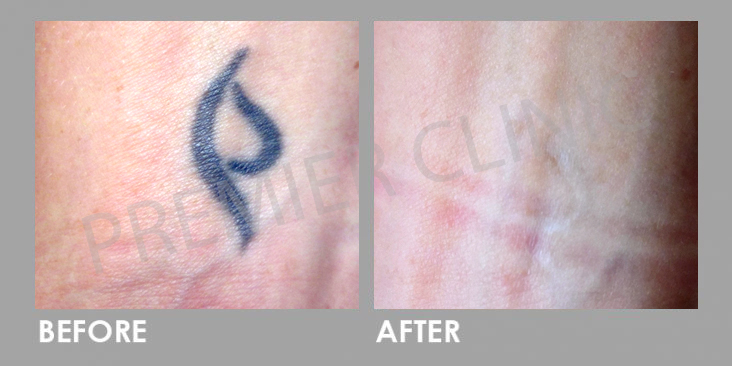 PICO Laser for tatto removal Before After 