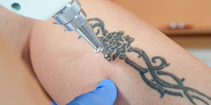 Tattoo-Removal with Pico Laser