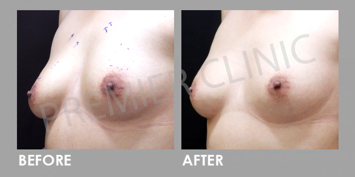 Breast Botox Before After