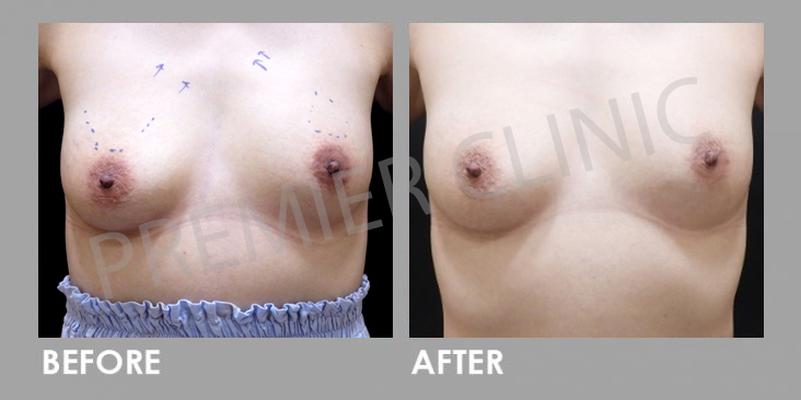 Breast Botox Before After