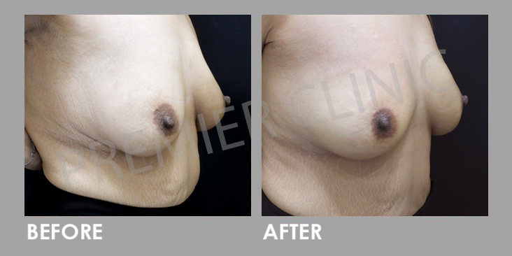 Breast PRP Before & After 