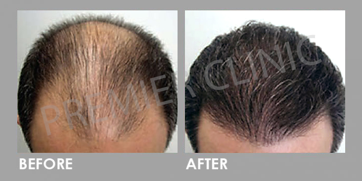 Premier Signature Hair Growth Laser Before After 