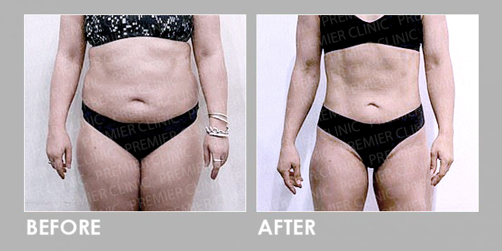 BEFORE & AFTER LIPOCELL BODY RESHAPING